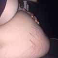 153502799975 stretch marks galore ive been feeling 3